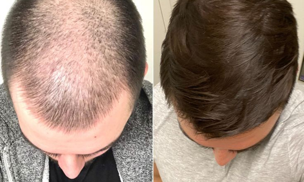 What is Scarless Hair Transplant in Dubai: A Natural Restoration Guide