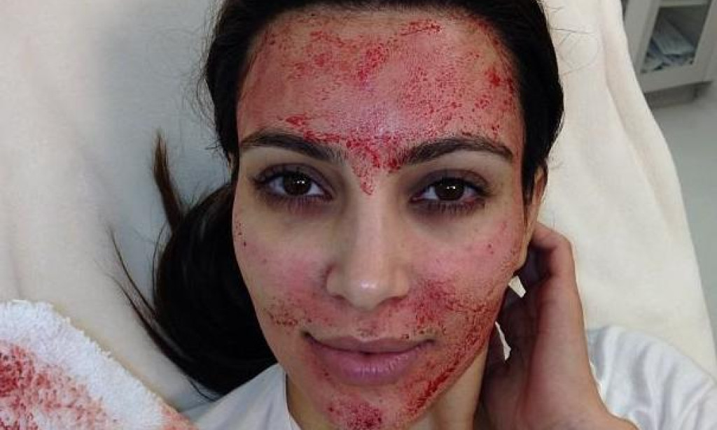 What Happens During a Vampire Facial Procedure?