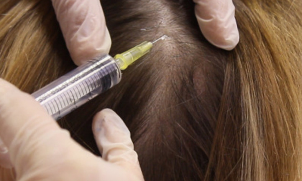 How Can G Cell Treatment Help Early Hair Loss?