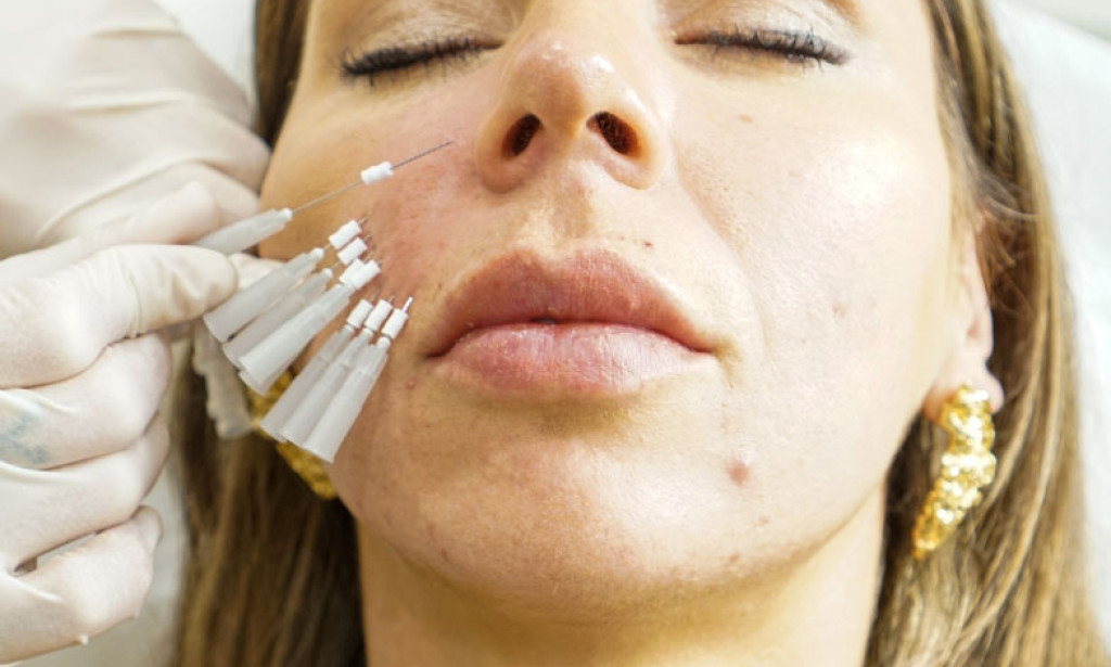 How Will PDO Mono Threads Make My Face Look Younger?