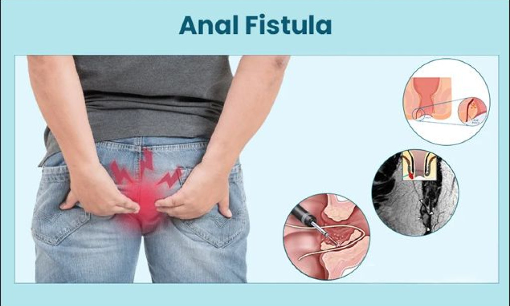 Why Ignoring Early Fistula Symptoms Can Lead to Bigger Health Problems: When to Seek the Best Fistula in Ano Treatment