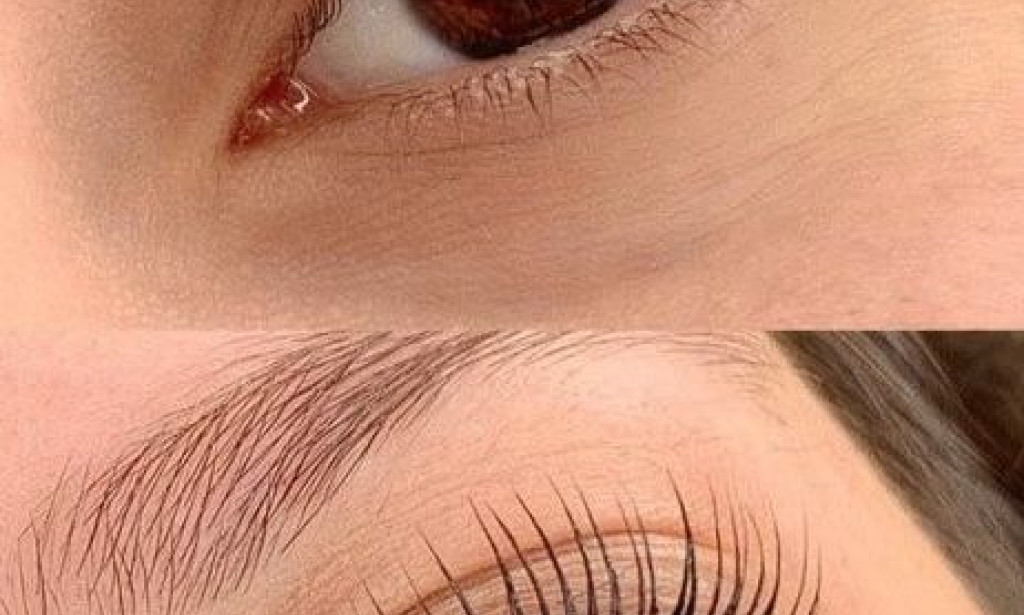 Eyelash hair transplant in Dubai: How to Get Permanent Lash Solution