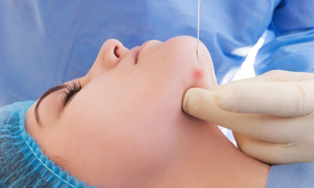 Top 5 Key Facts About Endolift Treatment and Facial Wrinkles