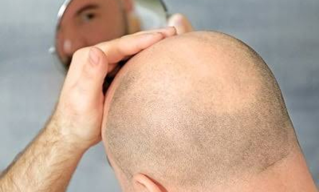 whatقبل وبعد زراعة الشعر: تحولات مذهلة ونتائج واقعية من عيادة تجميل دبي