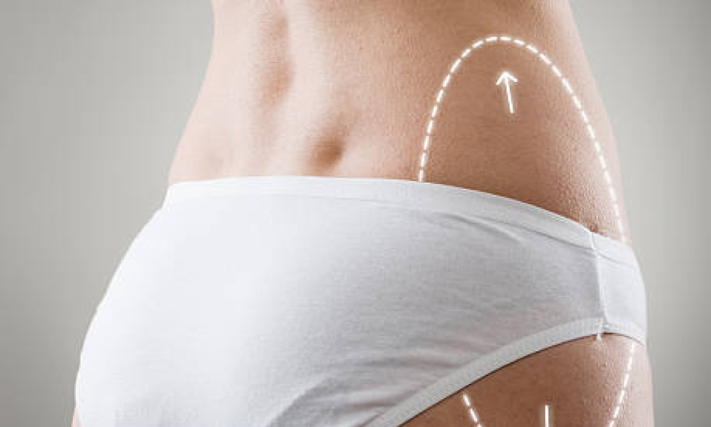 BodyTite Liposuction in Dubai: Where to Get Safe Fat Removal with Skin Tightening