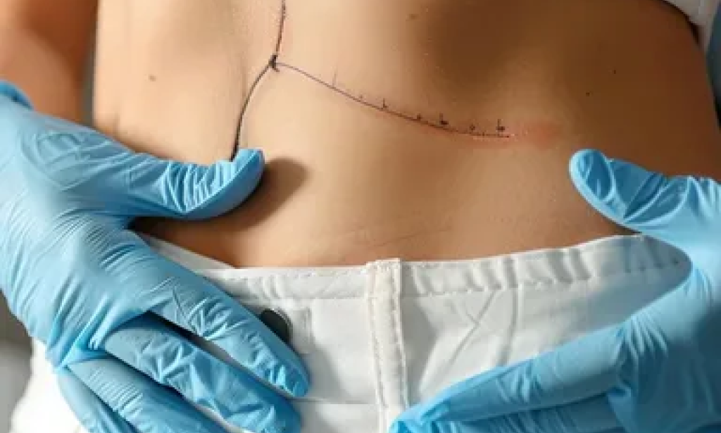 Tummy Tuck in Dubai: How Defining Your Midsection Through Science