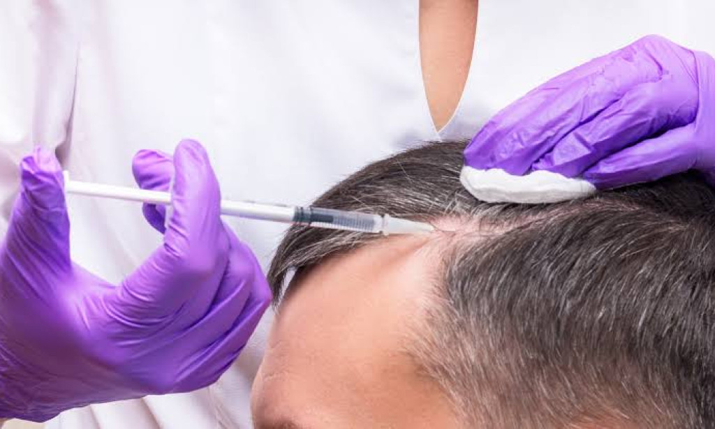 What Role Does PRP Hair Treatment Play in Hair Care?