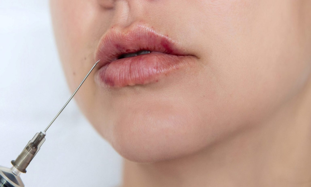 How Lip Filler Ideal for Soft and Balanced Lip Contours?