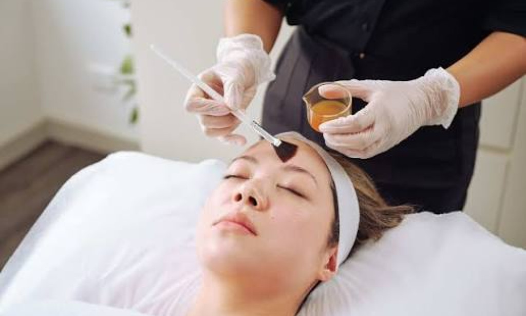 How Can Chemical Peel Help Reduce Visible Skin Imperfections?