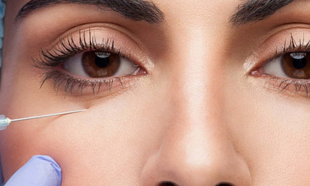 What Should You Know Before Getting Under Eye Fillers?