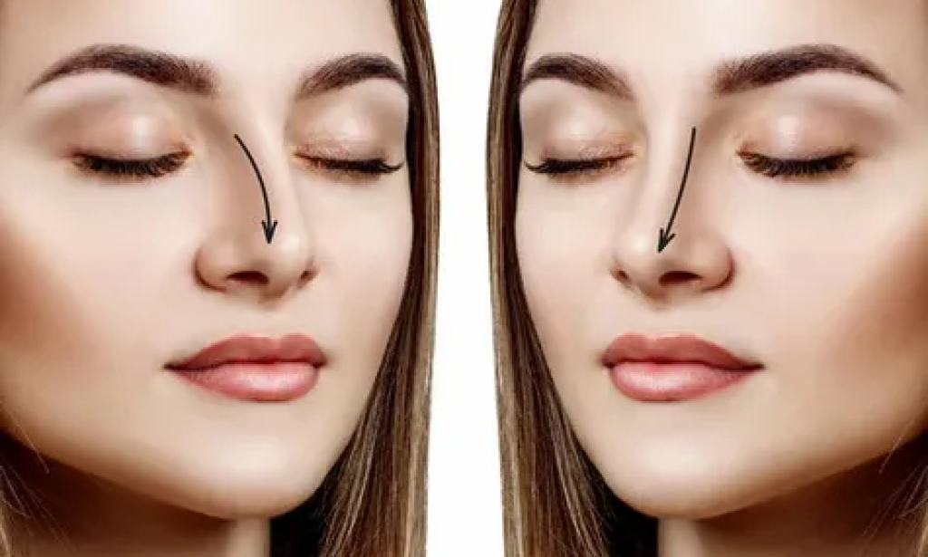 Rhinoplasty in Dubai: How to Define Your Facial Symmetry