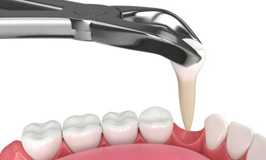 Top Benefits of Choosing Painless Wisdom Tooth Removal in Nagpur