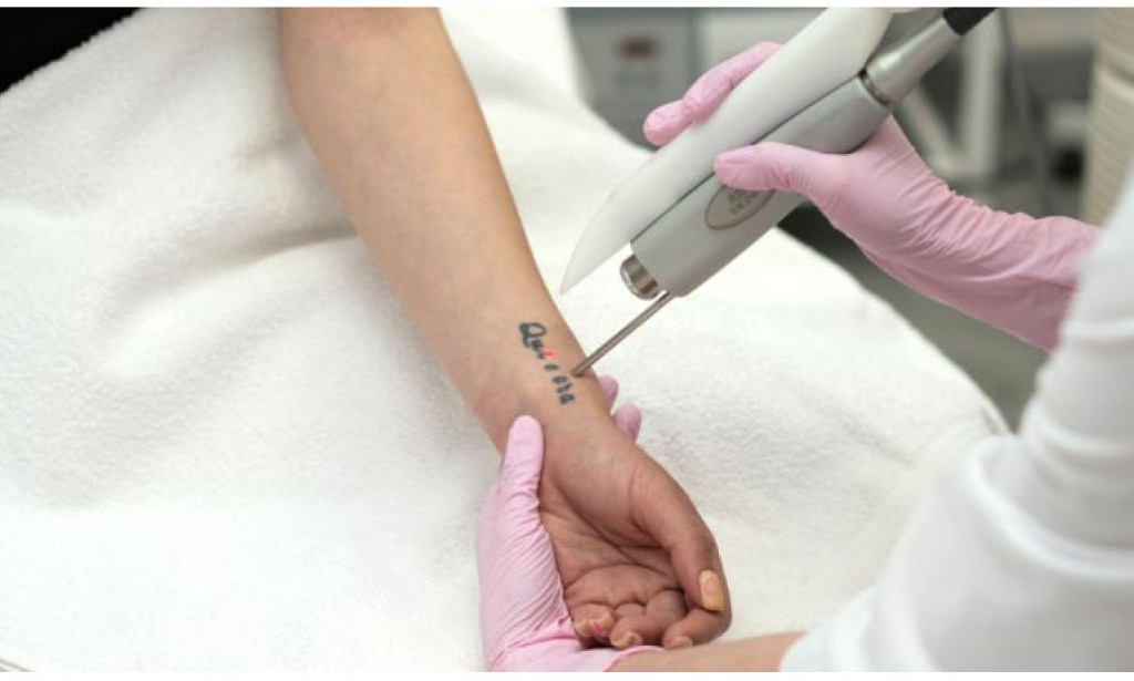 How Is Tattoo Removal Helpful for Unwanted Tattoo Styles?