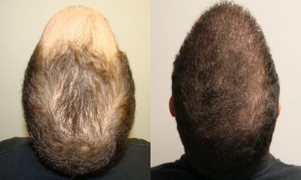 HOW Hair Transplant Dubai: Excellence in Hair Surgery