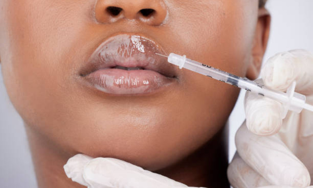 What Makes Lip Fillers Ideal for Smooth Lip Contours?