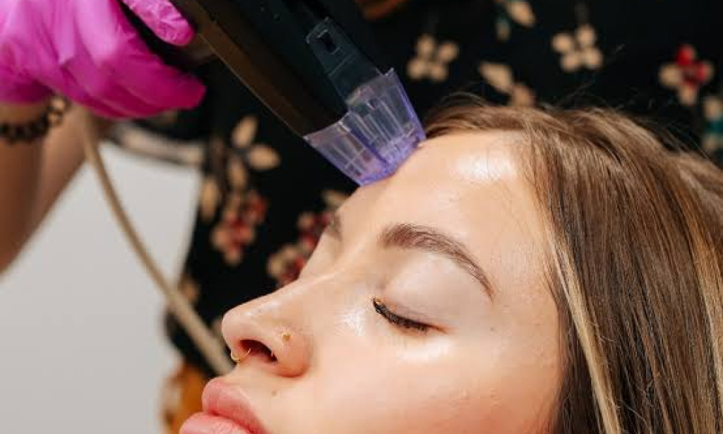 How Can Morpheus8 Therapy Help Delay Visible Signs of Aging?
