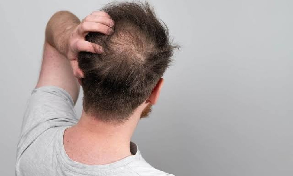 What Are The Signs You Need A Crown Hair Transplant?