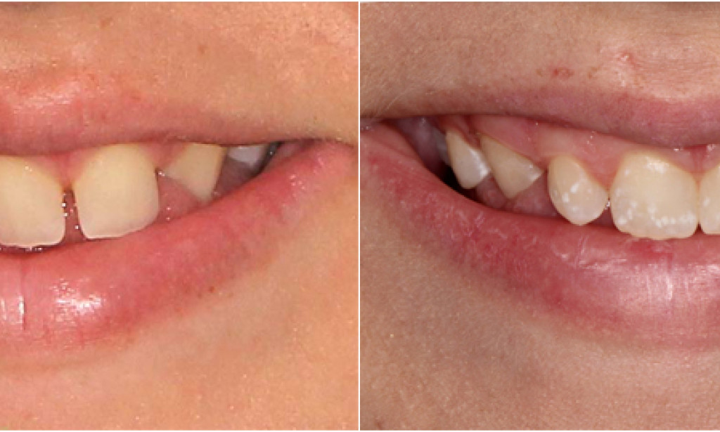 Top Emergency Dental Care for Sports Injuries and Active Lifestyles