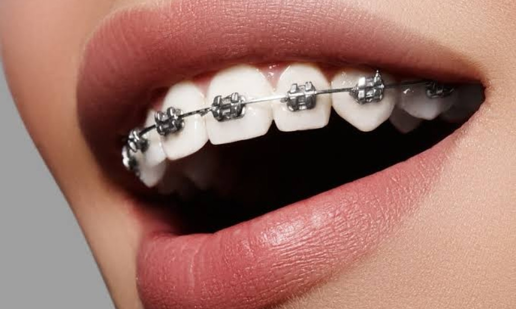What Foods Should You Avoid During Braces Treatment?