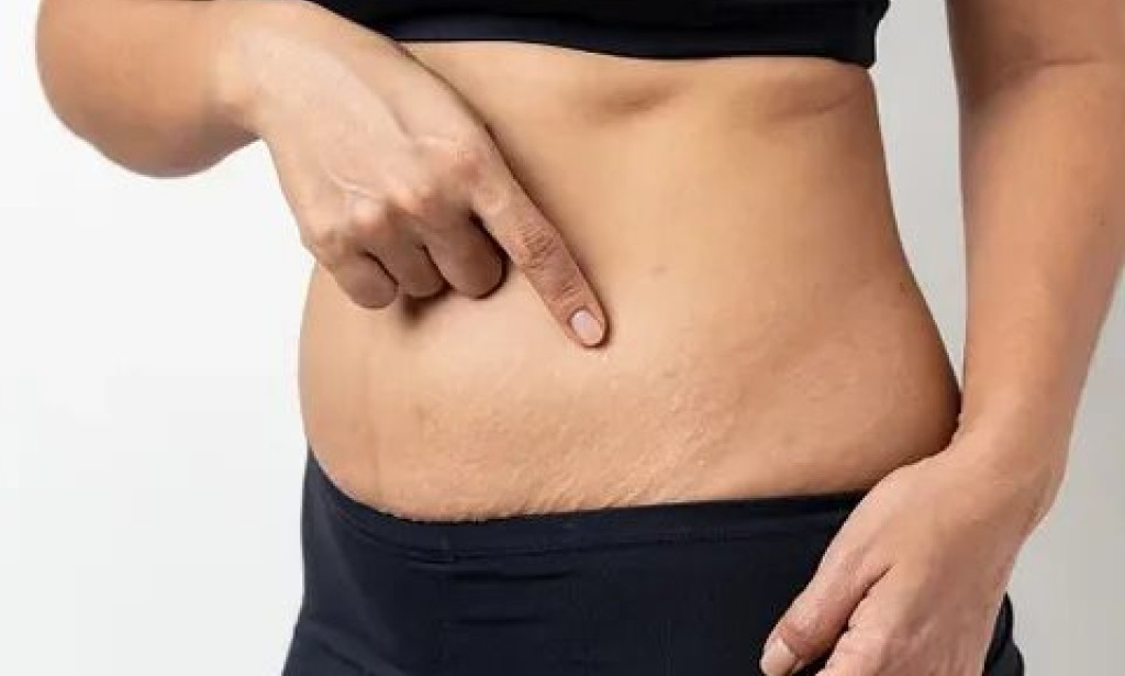 How Can Stretch Marks Removal Improve Abdomen Skin?